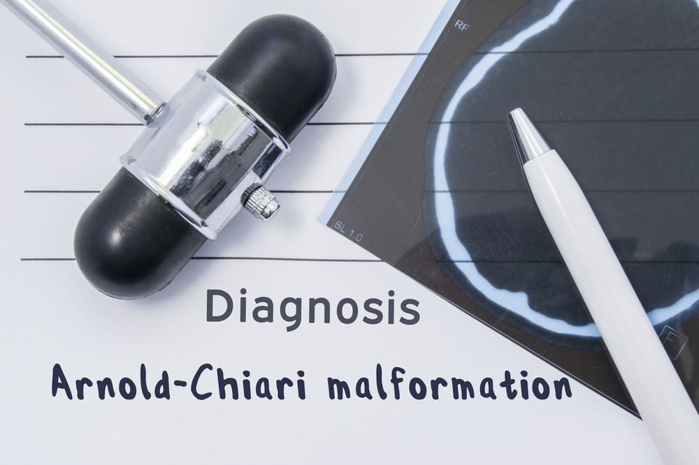ALLA SCOPERTA DI UNA MALATTIA RARA: SINDROME DI ARNOLD-CHIARI