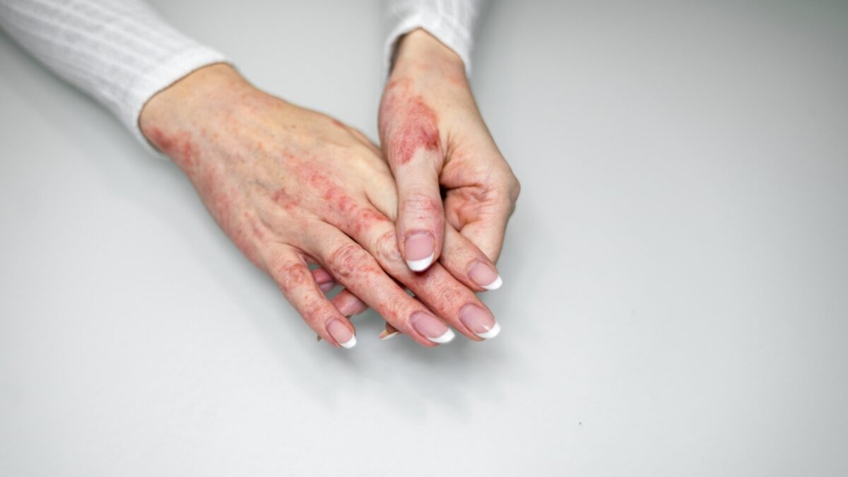 Dermatite da contatto sulla mano valutata dal dermatologo